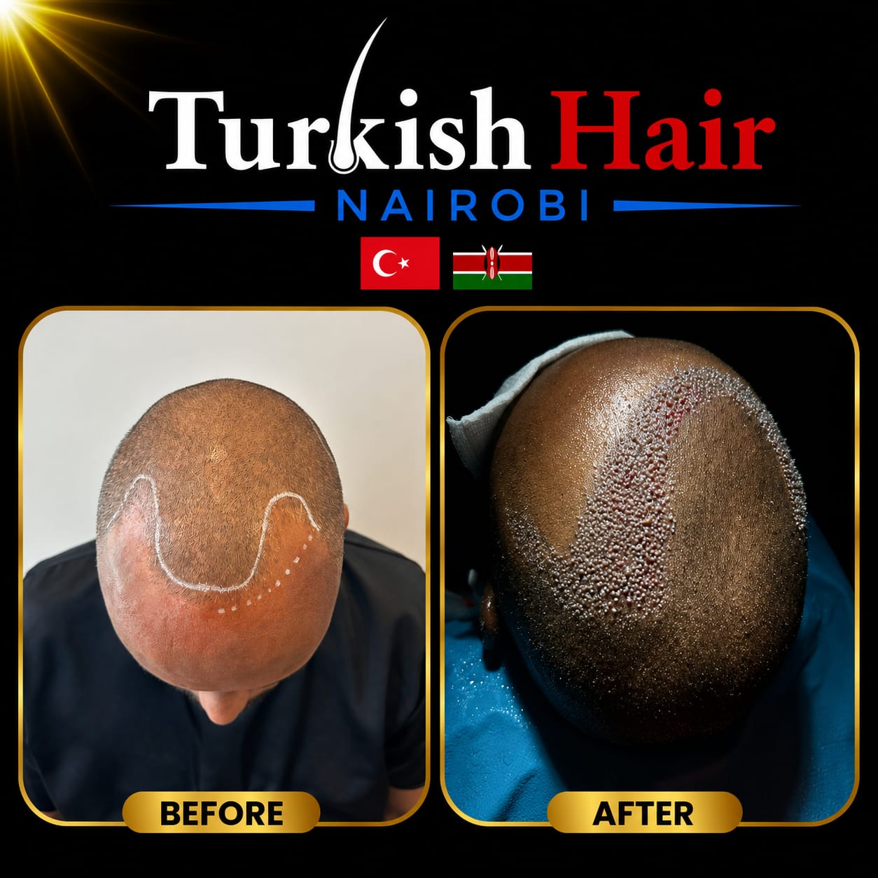 Turkish Hair Nairobi Case 4